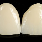 crownsceramic-generaldentistry