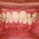 signs of gum disease