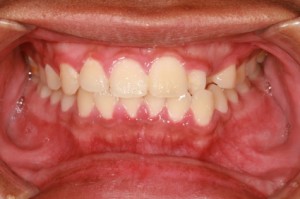 signs of gum disease
